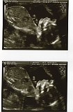 3rd Ultrasound 02